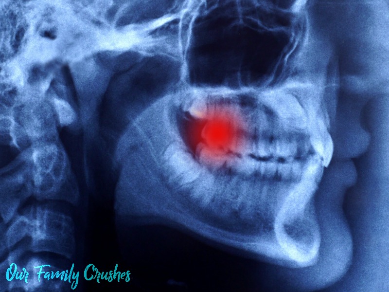 Dental infection on xray